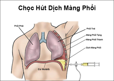 Kỹ thuật chọc thăm dò màng phổi có tác dụng gì?